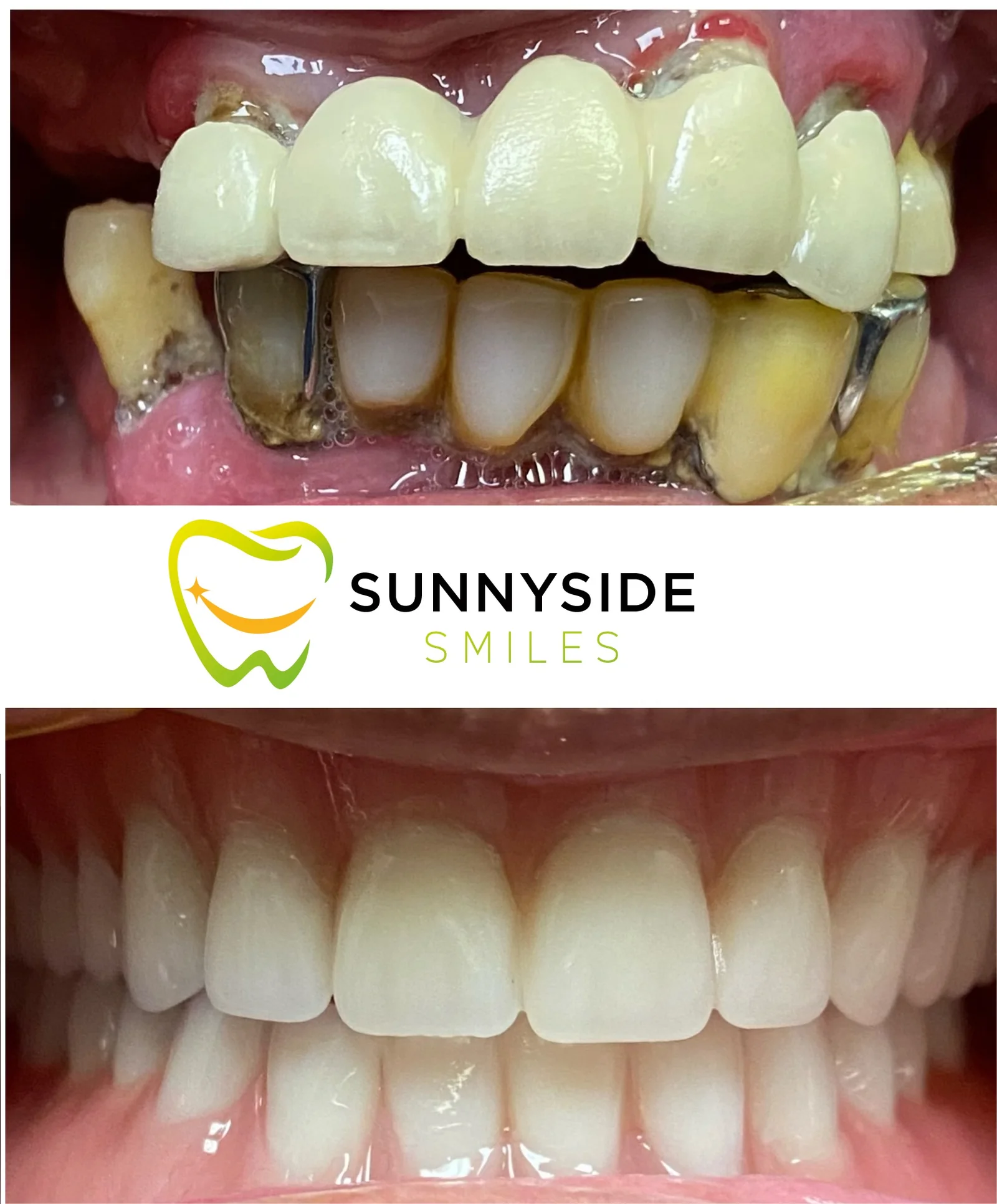 Before and after restorative smile makeover at Sunnyside Smiles