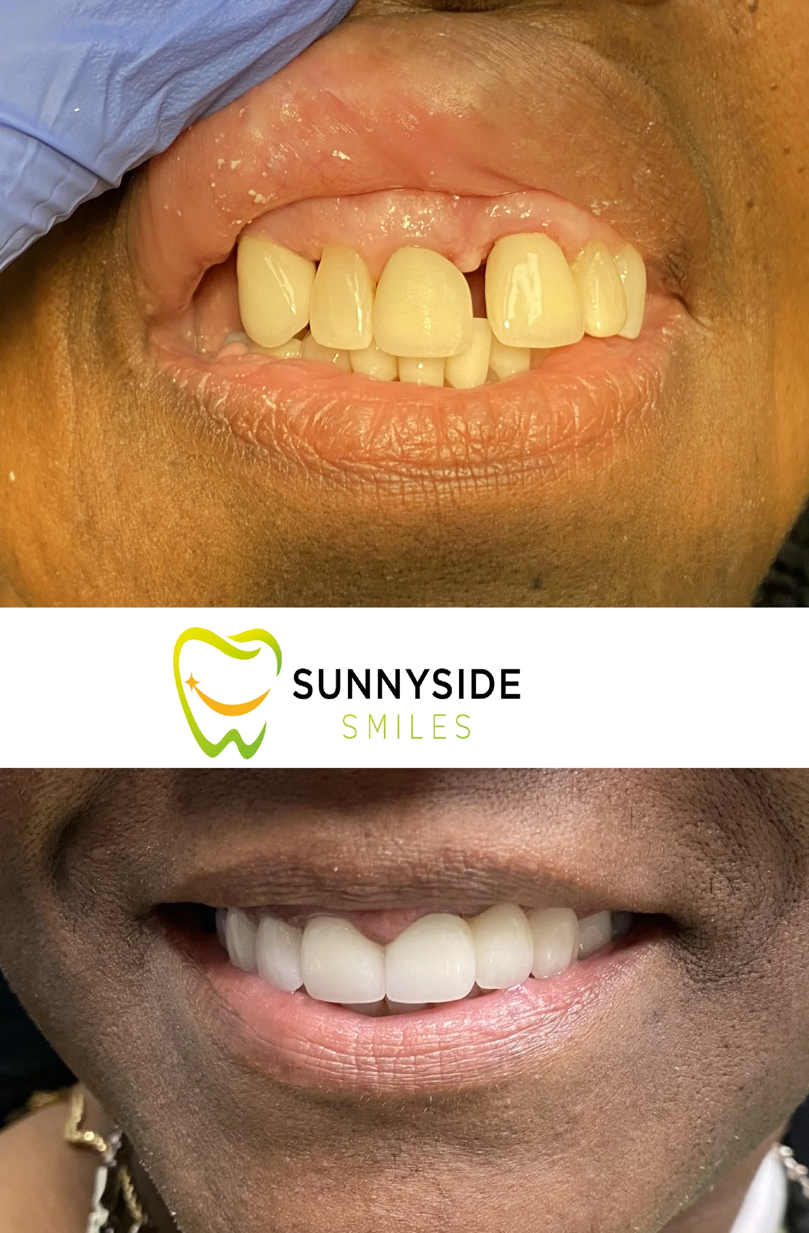 Before and after natural smile makeover at Sunnyside Smiles