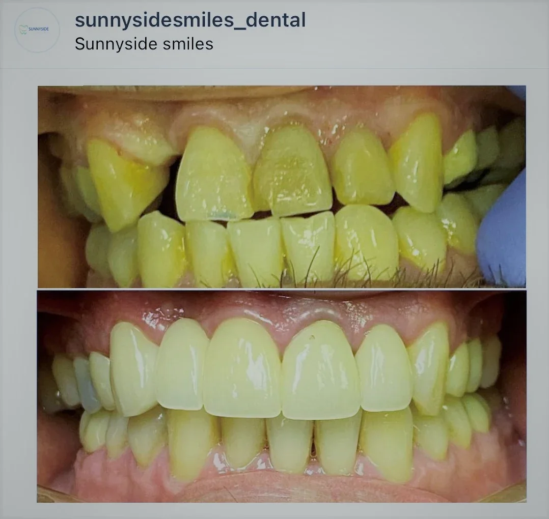 Before and after cosmetic smile refresh at Sunnyside Smiles